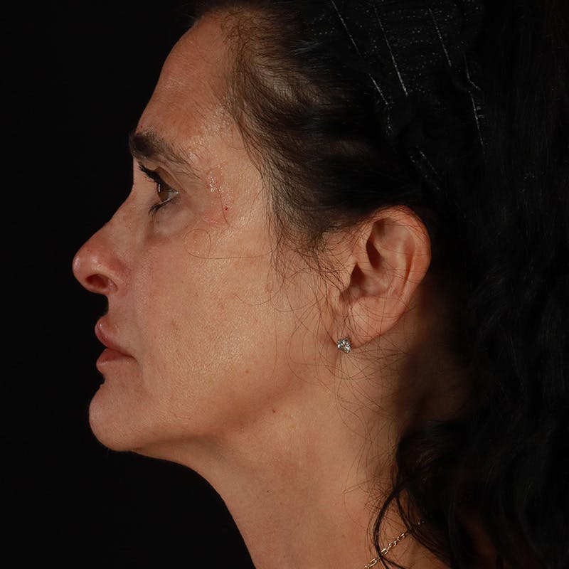 Dermal Fillers Before & After Gallery - Patient 904957 - Image 10