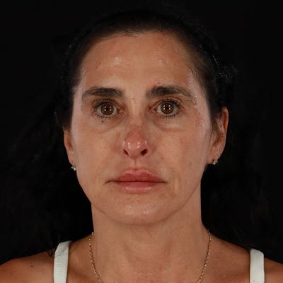 Dermal Fillers Before & After Gallery - Patient 904957 - Image 2