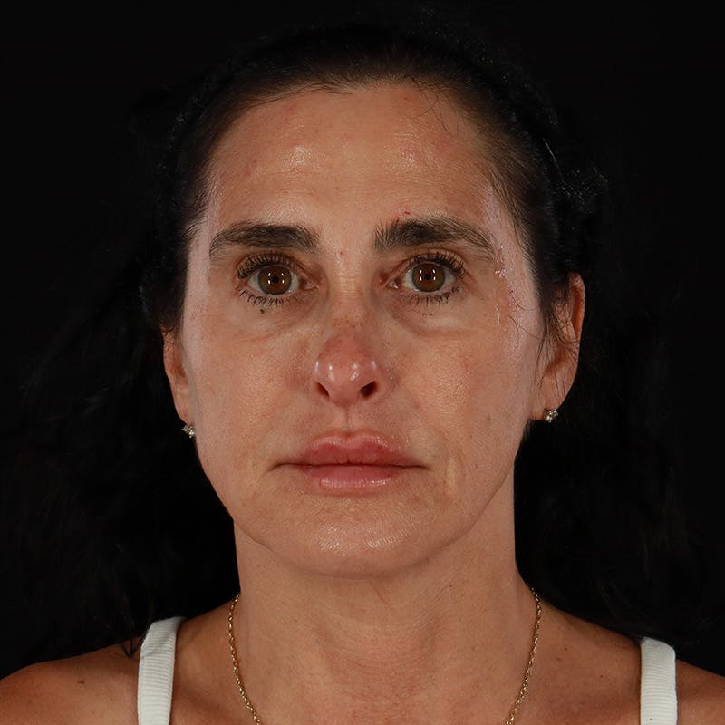 Dermal Fillers Before & After Gallery - Patient 904957 - Image 2
