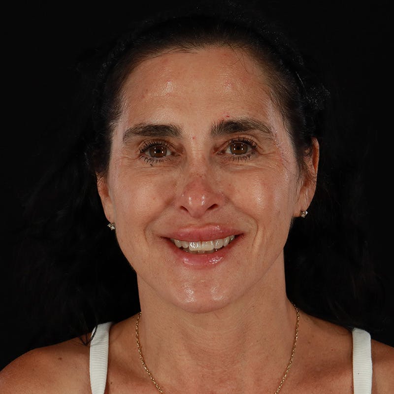 Dermal Fillers Before & After Gallery - Patient 904957 - Image 4