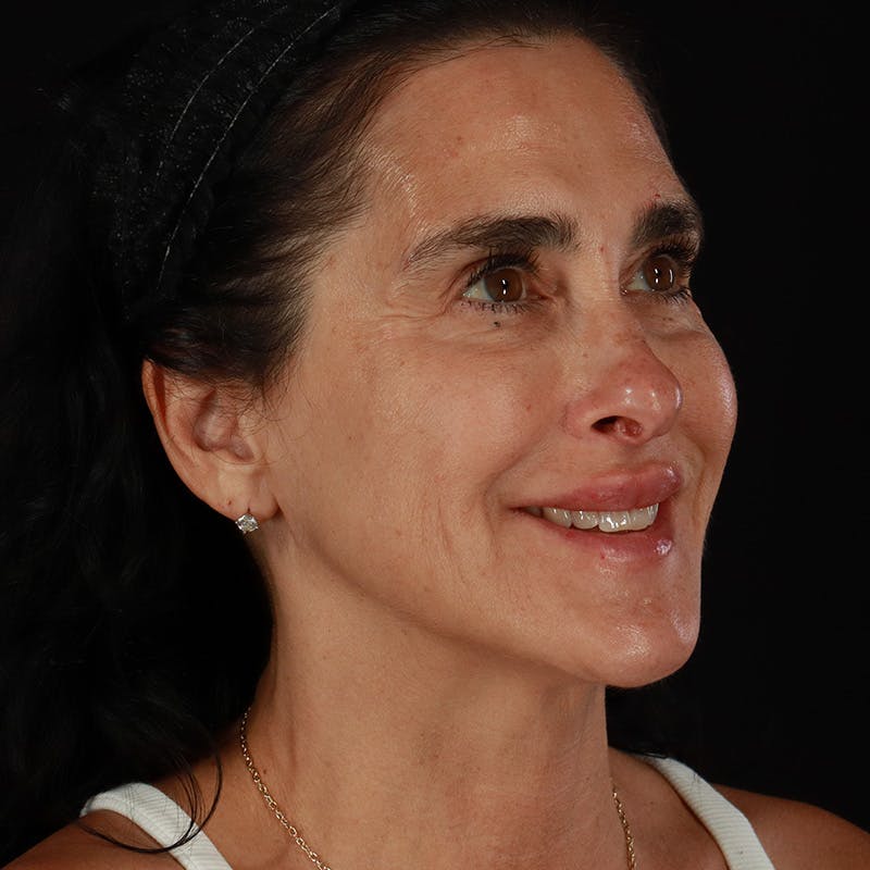 Dermal Fillers Before & After Gallery - Patient 904957 - Image 6