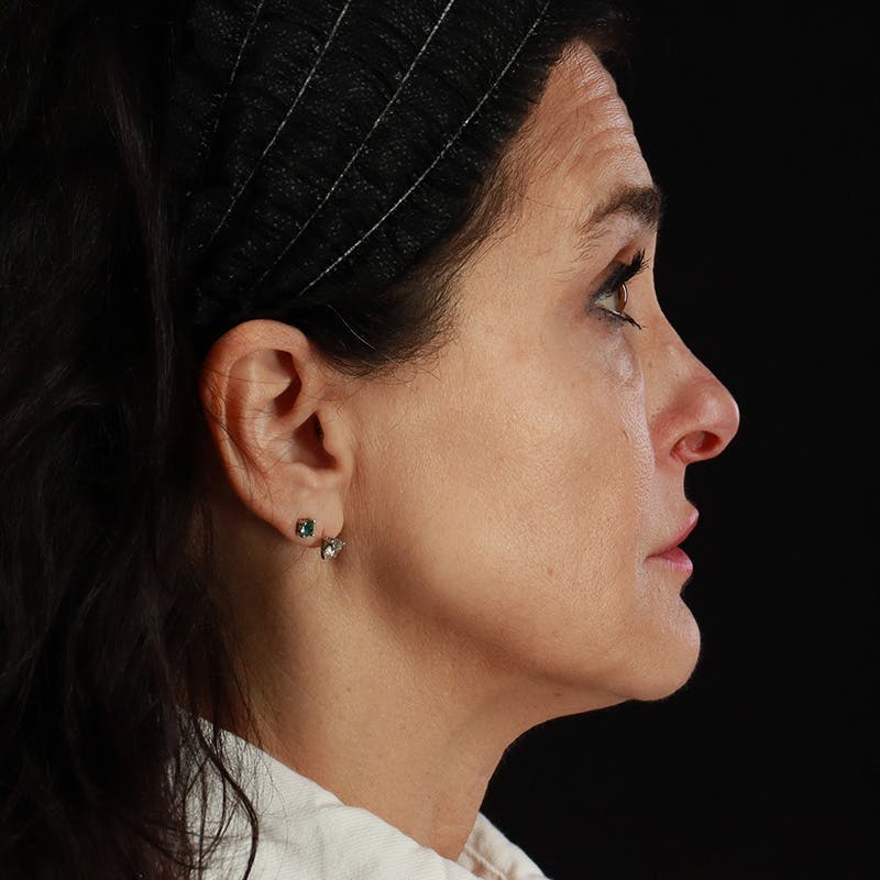 Dermal Fillers Before & After Gallery - Patient 904957 - Image 7