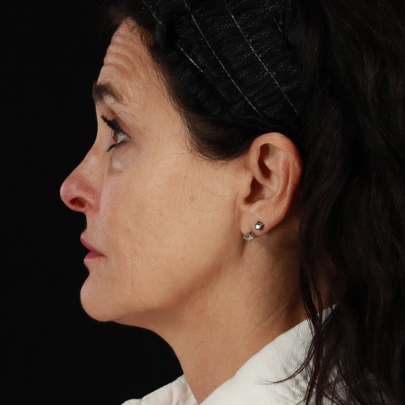 Dermal Fillers Before & After Gallery - Patient 904957 - Image 9