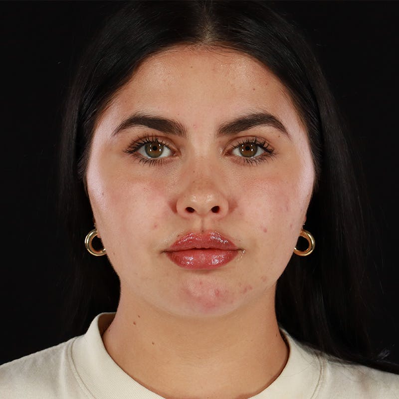 Dermal Fillers Before & After Gallery - Patient 283366 - Image 1
