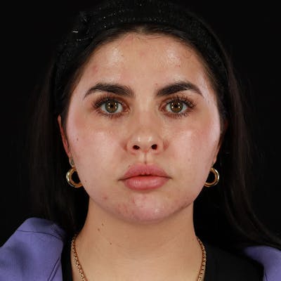 Dermal Fillers Before & After Gallery - Patient 283366 - Image 2