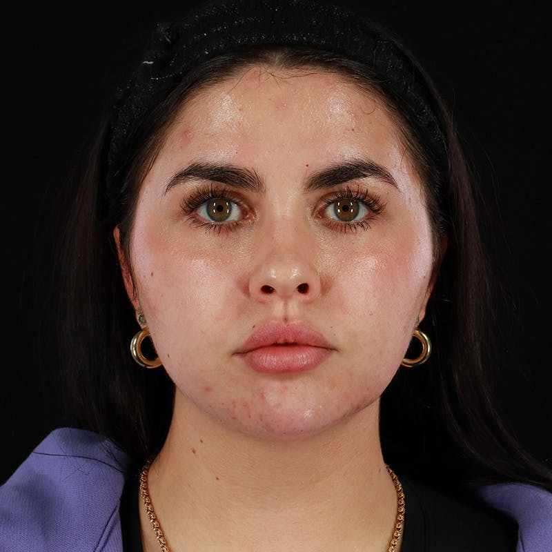 Dermal Fillers Before & After Gallery - Patient 283366 - Image 2