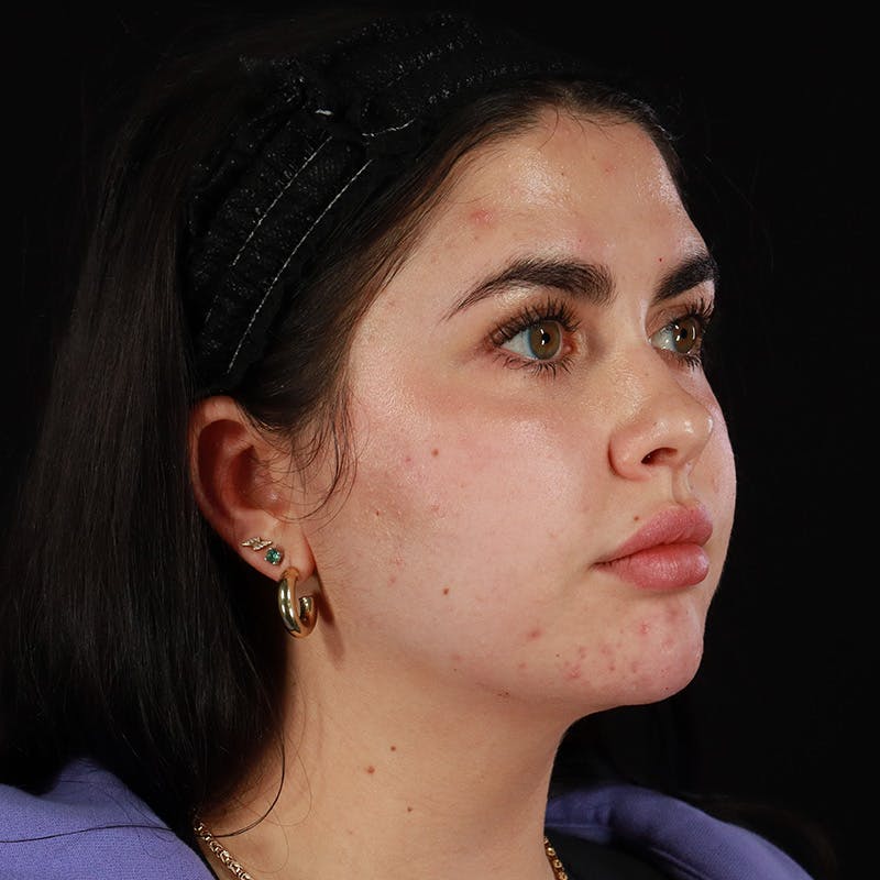 Dermal Fillers Before & After Gallery - Patient 283366 - Image 4