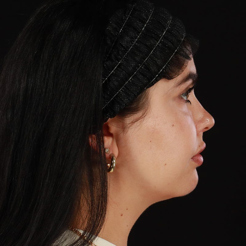 Dermal Fillers Before & After Gallery - Patient 283366 - Image 5