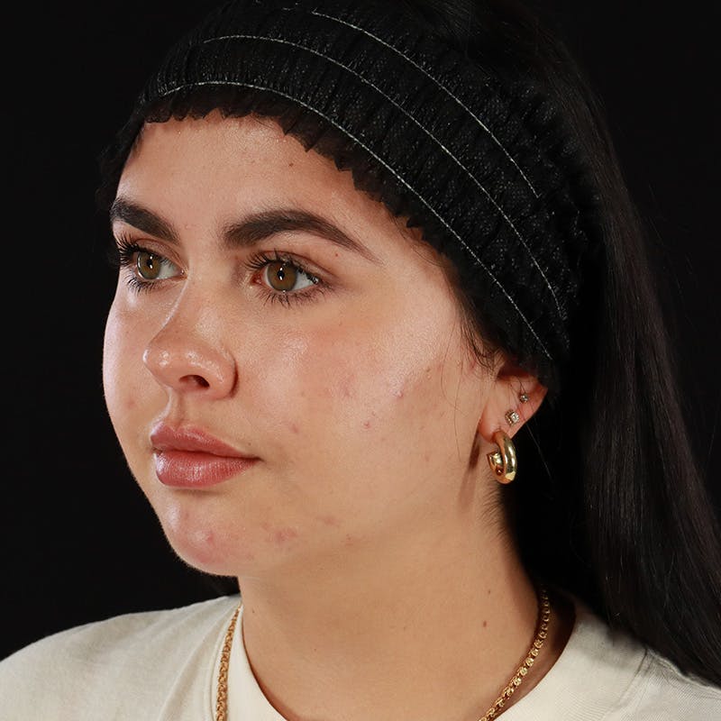 Dermal Fillers Before & After Gallery - Patient 283366 - Image 7