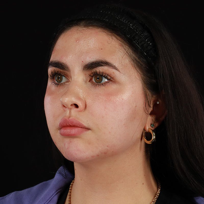 Dermal Fillers Before & After Gallery - Patient 283366 - Image 8