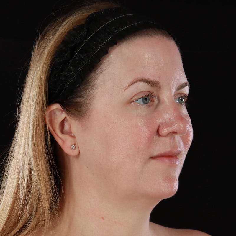 HALO™ Laser Treatment Before & After Gallery - Patient 380703 - Image 4