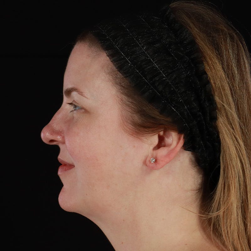 HALO™ Laser Treatment Before & After Gallery - Patient 380703 - Image 9