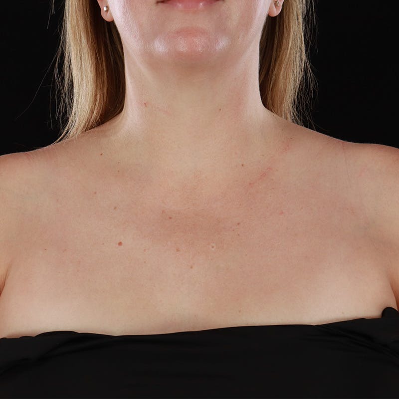 HALO™ Laser Treatment Before & After Gallery - Patient 380703 - Image 12