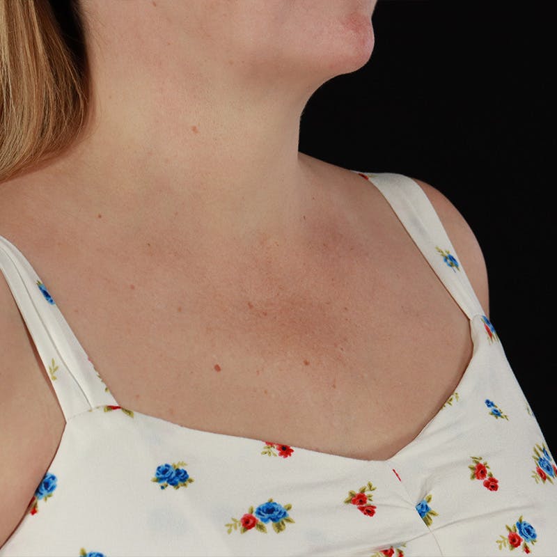 HALO™ Laser Treatment Before & After Gallery - Patient 380703 - Image 13