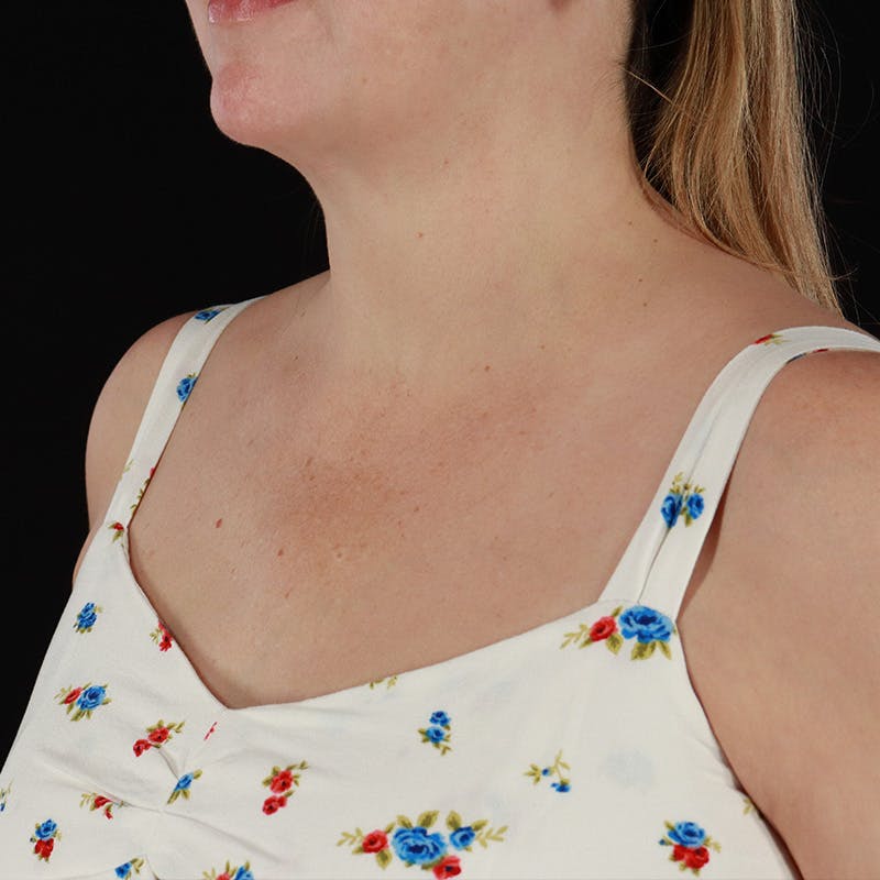 HALO™ Laser Treatment Before & After Gallery - Patient 380703 - Image 15