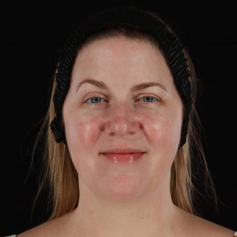 HALO™ Laser Treatment Before & After Gallery - Patient 380703 - Image 1