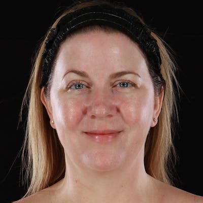 BroadBand Light™ Therapy Before & After Gallery - Patient 467568 - Image 2