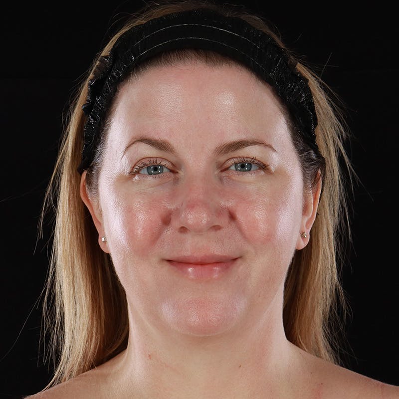 HALO™ Laser Treatment Before & After Gallery - Patient 380703 - Image 2