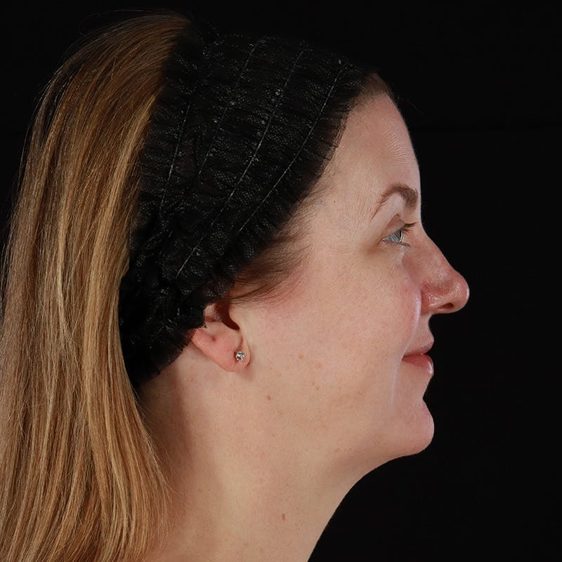 HALO™ Laser Treatment Before & After Gallery - Patient 380703 - Image 5