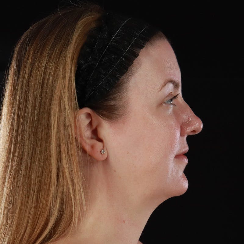 HALO™ Laser Treatment Before & After Gallery - Patient 380703 - Image 6