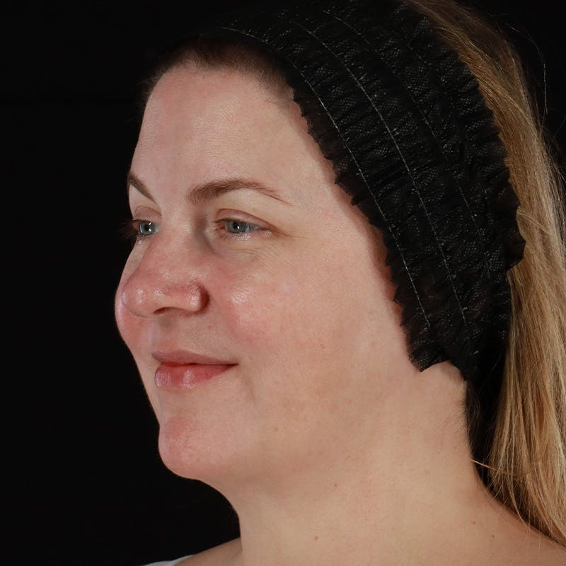 HALO™ Laser Treatment Before & After Gallery - Patient 380703 - Image 7