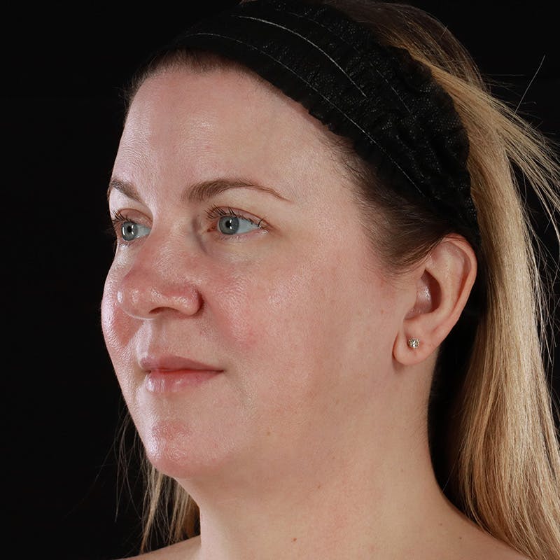 HALO™ Laser Treatment Before & After Gallery - Patient 380703 - Image 8