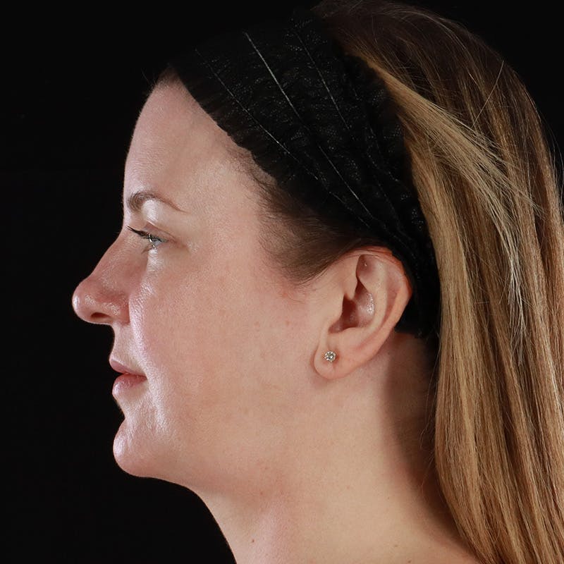 HALO™ Laser Treatment Before & After Gallery - Patient 380703 - Image 10
