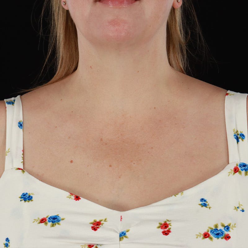 HALO™ Laser Treatment Before & After Gallery - Patient 380703 - Image 11