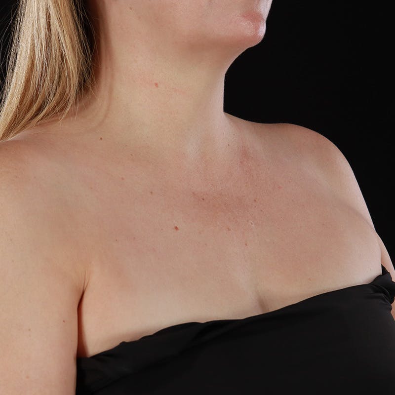 HALO™ Laser Treatment Before & After Gallery - Patient 380703 - Image 14