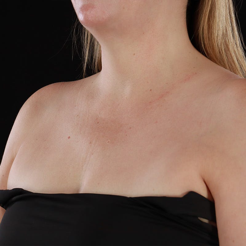 HALO™ Laser Treatment Before & After Gallery - Patient 380703 - Image 16