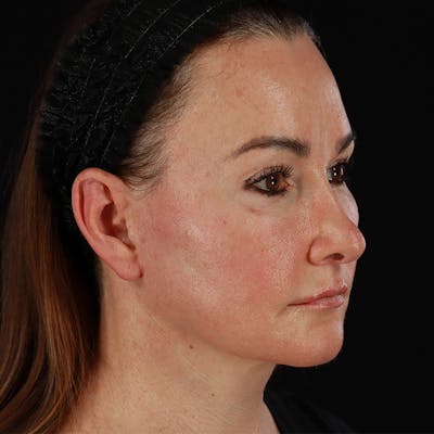 BroadBand Light™ Therapy Before & After Gallery - Patient 127195 - Image 1