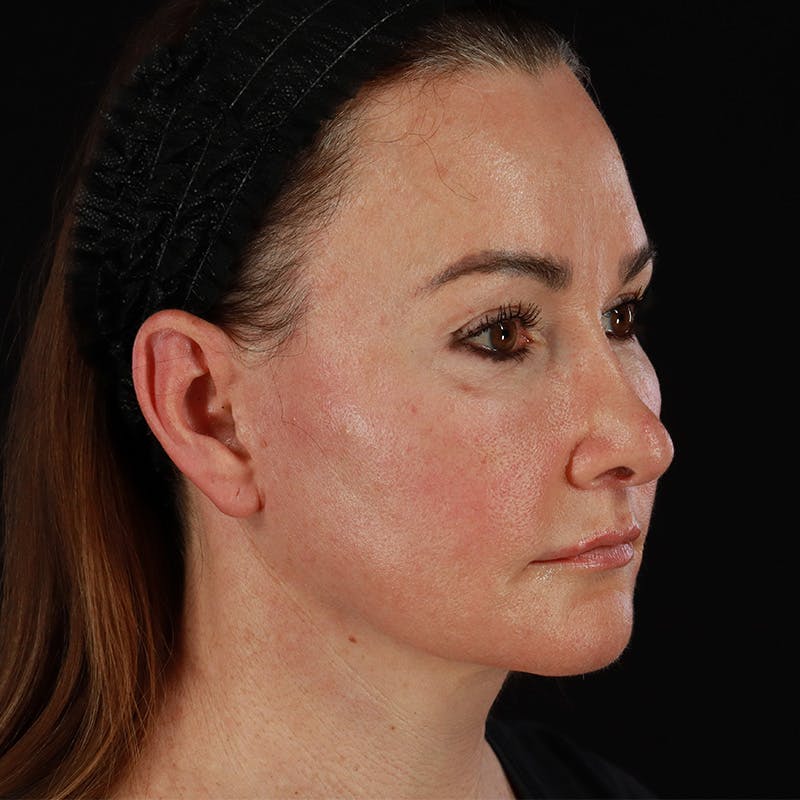 HALO™ Laser Treatment Before & After Gallery - Patient 303100 - Image 1