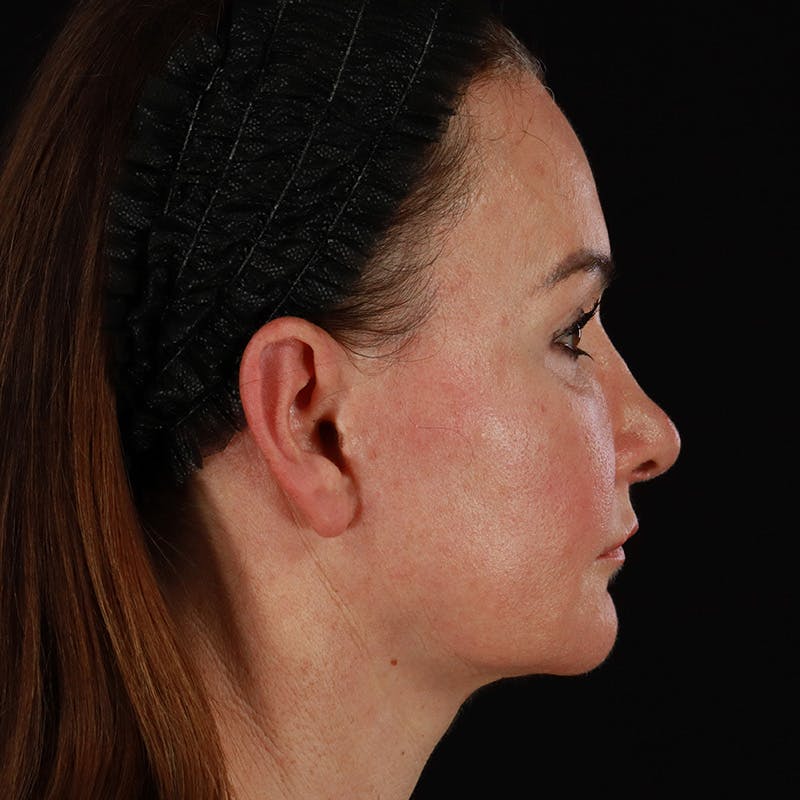 HALO™ Laser Treatment Before & After Gallery - Patient 303100 - Image 3