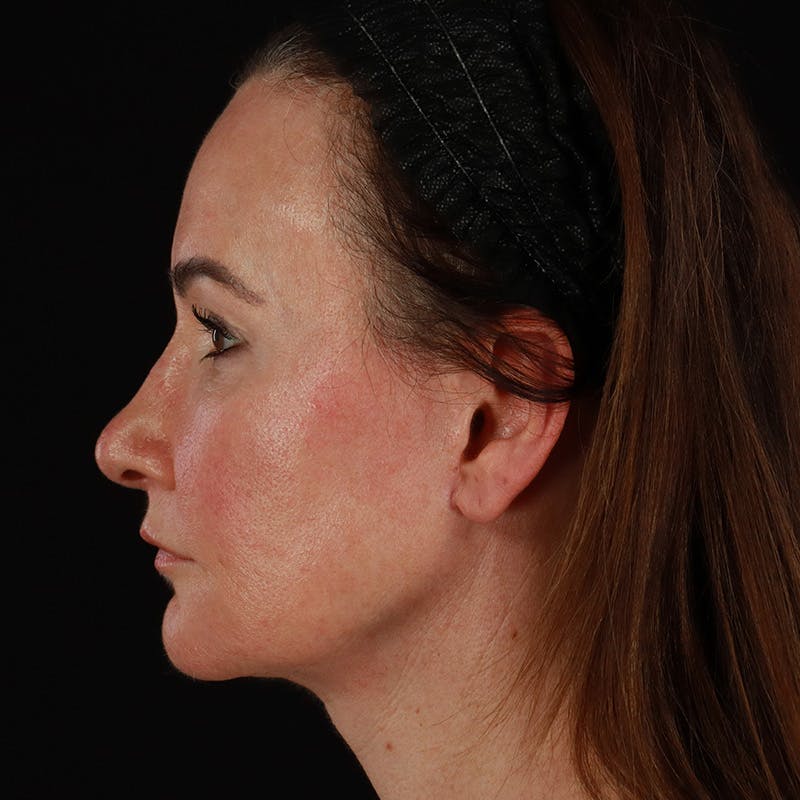 HALO™ Laser Treatment Before & After Gallery - Patient 303100 - Image 5
