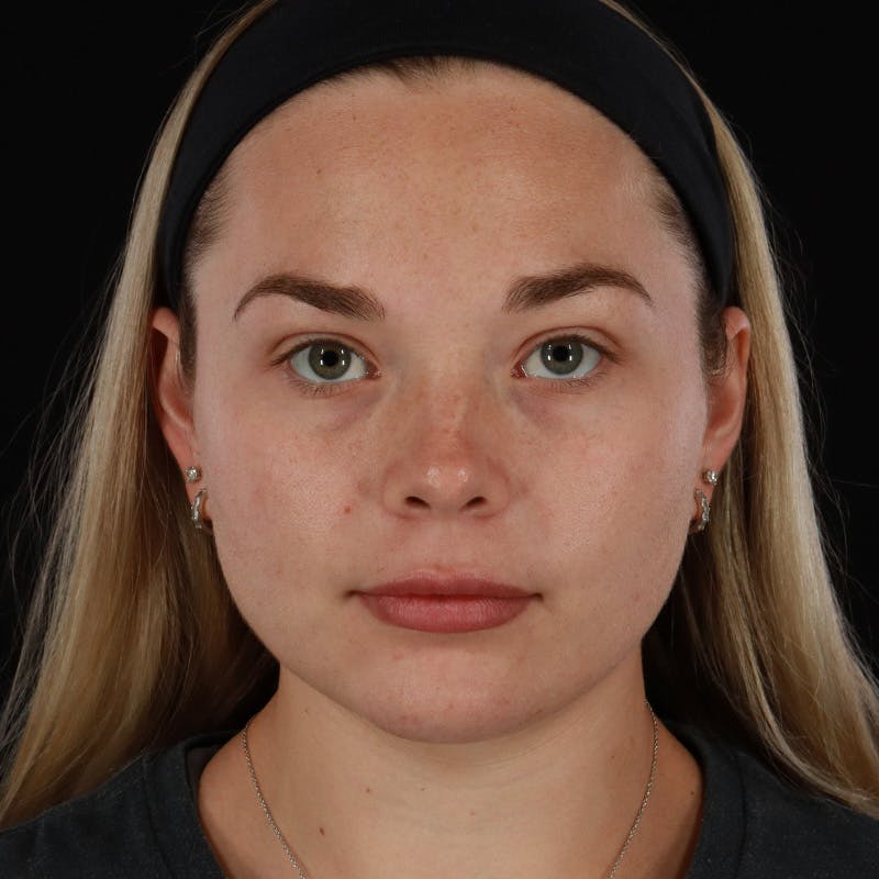 HALO™ Laser Treatment Before & After Gallery - Patient 263838 - Image 1