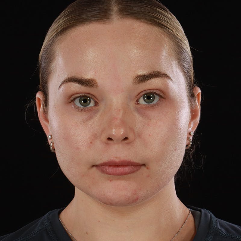 HALO™ Laser Treatment Before & After Gallery - Patient 263838 - Image 2