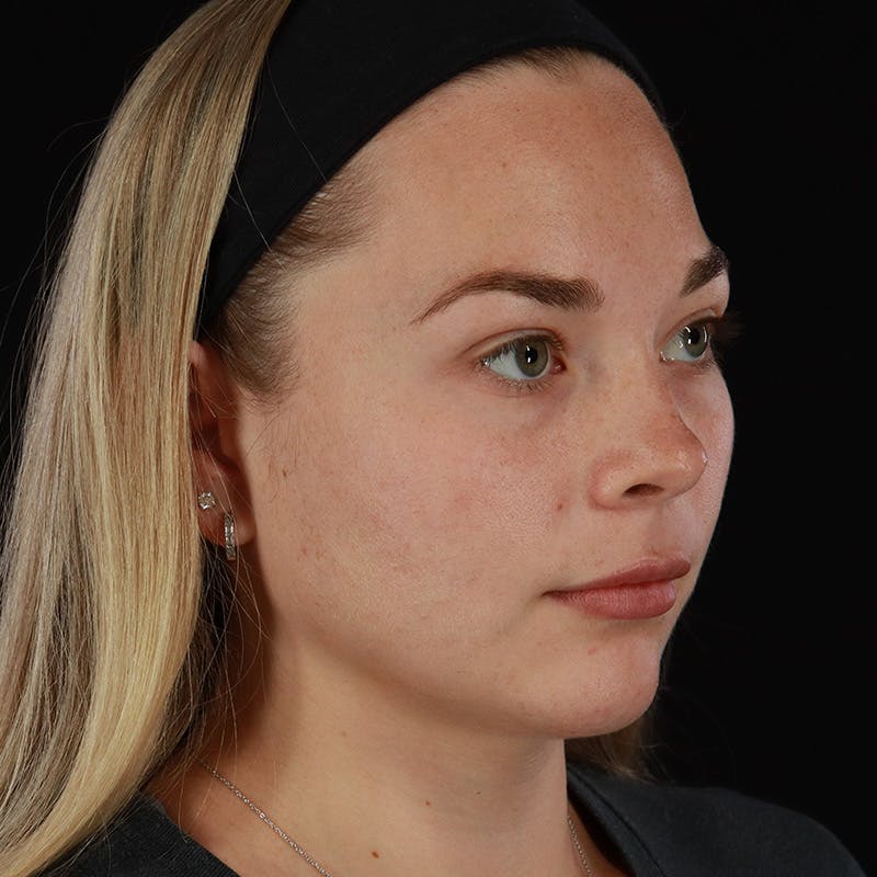 HALO™ Laser Treatment Before & After Gallery - Patient 263838 - Image 3