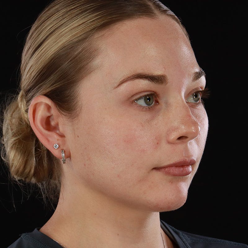 HALO™ Laser Treatment Before & After Gallery - Patient 263838 - Image 4