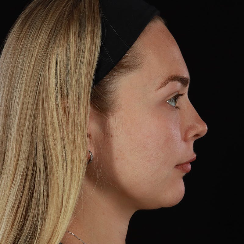 HALO™ Laser Treatment Before & After Gallery - Patient 263838 - Image 5