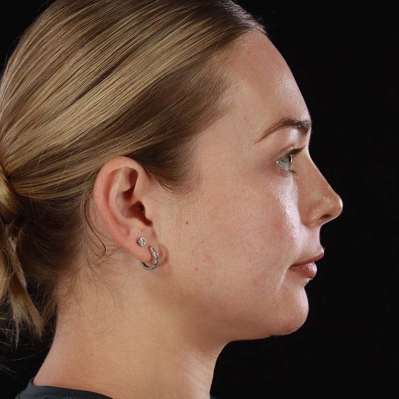 HALO™ Laser Treatment Before & After Gallery - Patient 263838 - Image 6