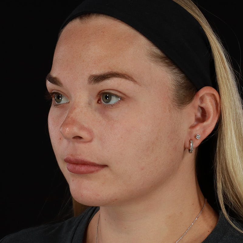 HALO™ Laser Treatment Before & After Gallery - Patient 263838 - Image 7