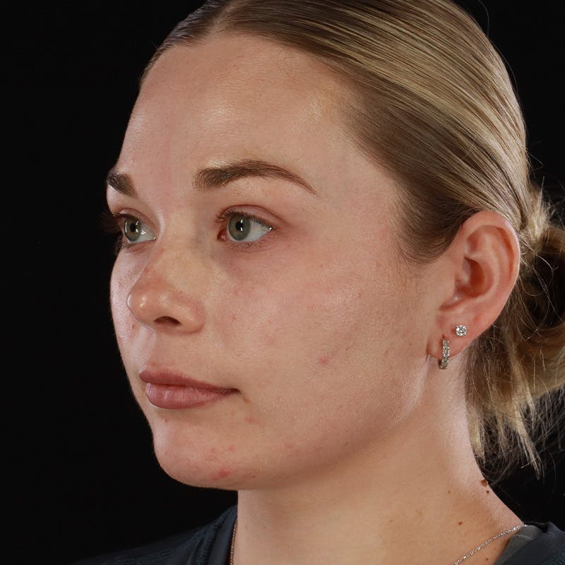 HALO™ Laser Treatment Before & After Gallery - Patient 263838 - Image 8