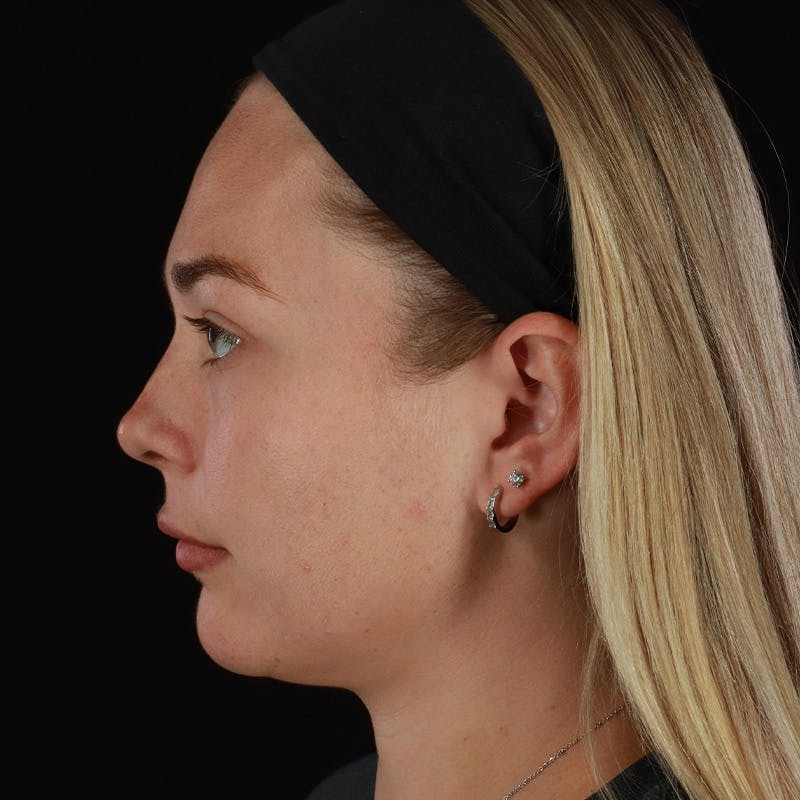 HALO™ Laser Treatment Before & After Gallery - Patient 263838 - Image 9