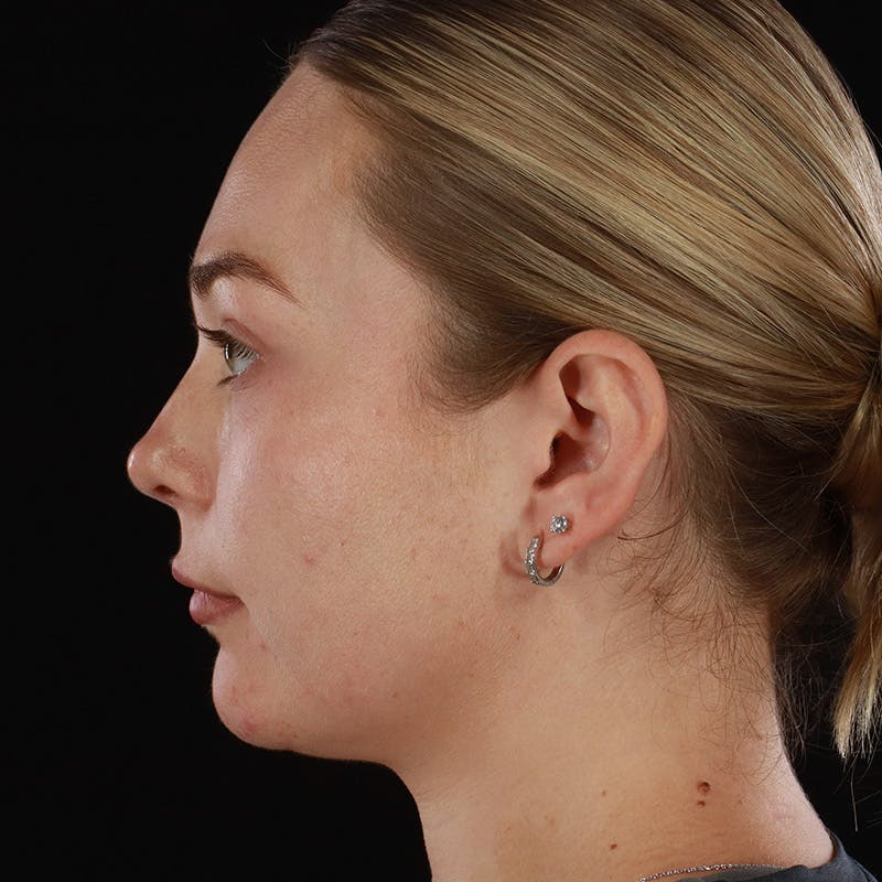 HALO™ Laser Treatment Before & After Gallery - Patient 263838 - Image 10