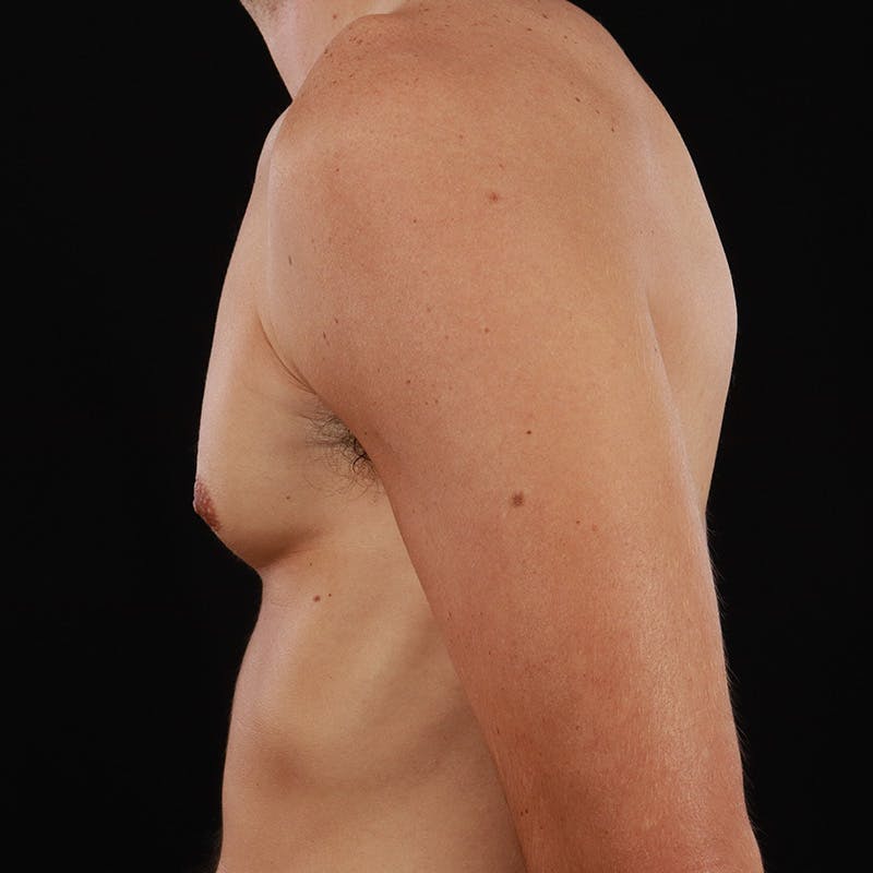 Gynecomastia Before & After Gallery - Patient 182904 - Image 9