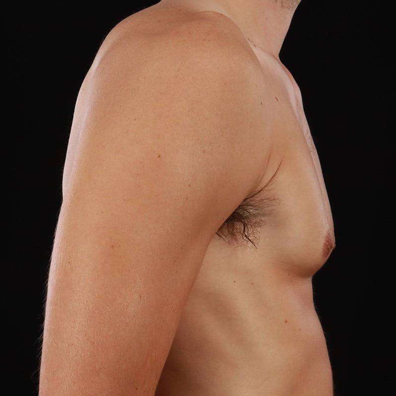 Gynecomastia Before & After Gallery - Patient 182904 - Image 5