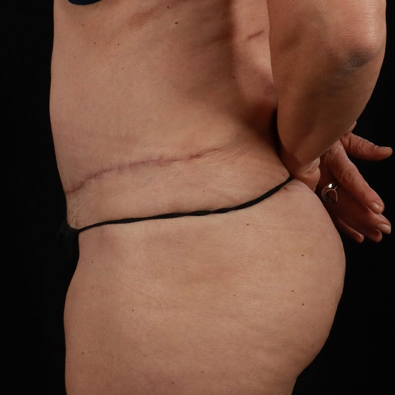 Abdominoplasty (Tummy Tuck) Before & After Gallery - Patient 350514 - Image 10