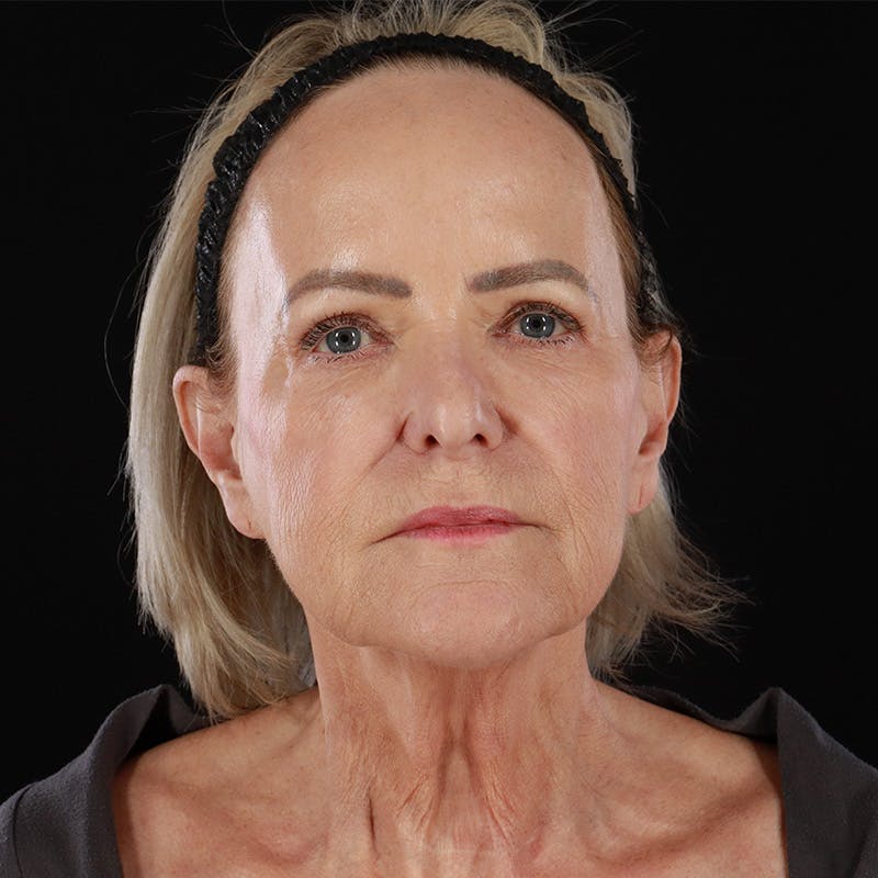 Facelift Before & After Gallery - Patient 146873 - Image 1