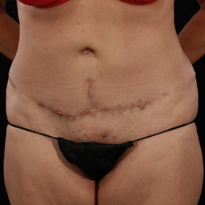 Abdominoplasty (Tummy Tuck) Before & After Gallery - Patient 350514 - Image 1