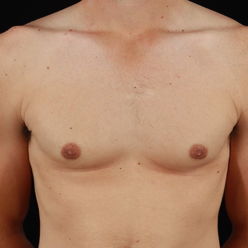Gynecomastia Before & After Gallery - Patient 182904 - Image 2